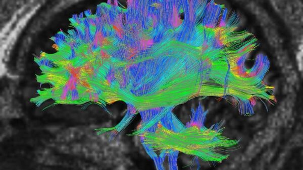 Diffusion MRI, also referred to as diffusion tensor imaging or DTI, of the human brain