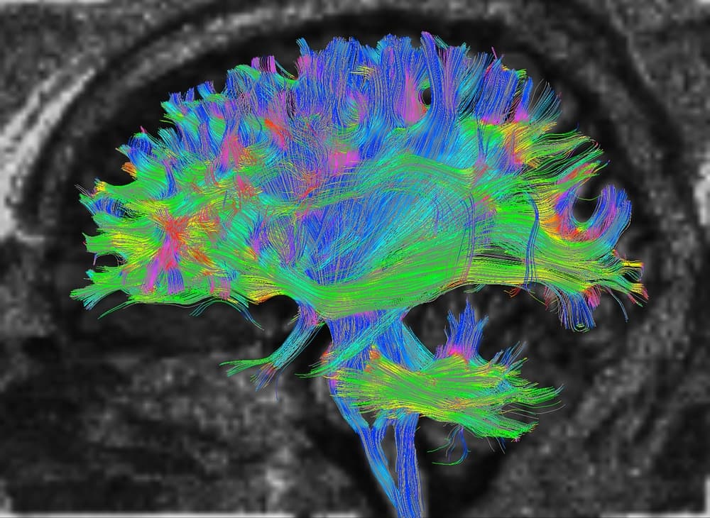 Diffusion MRI, also referred to as diffusion tensor imaging or DTI, of the human brain
