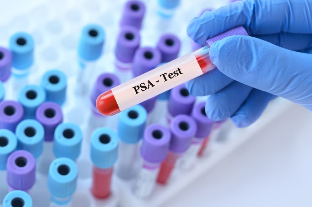 Doctor holding a test blood sample tube with PSA Prostate Specific Antigen test on the background of medical test tubes with analyzes