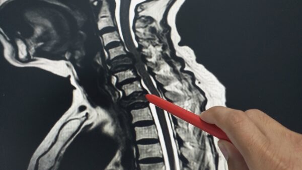 Cervical MRI scan used as evidence of soft tissue damage in a whiplash claim