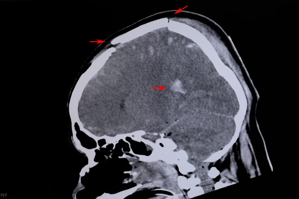 CT scan showing traumatic brain injury with highlighted areas of internal damage